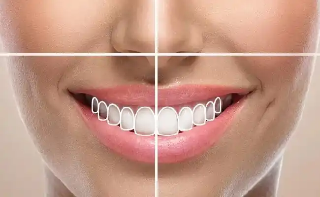 تصویری از مراحل طراحی لبخند دیجیتال در دندانپزشکی