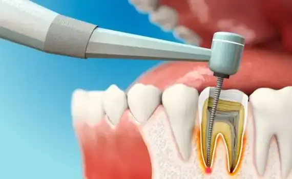 تصویری از دستگاه روتاری برای عصب‌کشی و درمان ریشه دندان در مطب دندانپزشکی ساوه